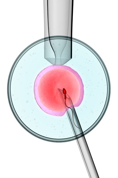 Kinderwunschbehandlung - künstliche Befruchtung
